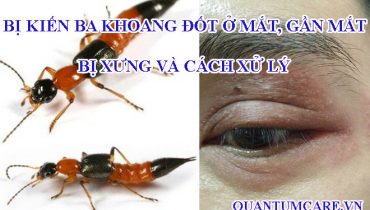 Bị kiến ba khoang đốt ở mắt, gần mắt, bị xưng và cách xử lý