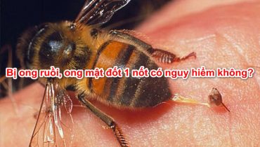 Bị ong ruồi, ong mật đốt 1 nốt có nguy hiểm không, có sưng không?