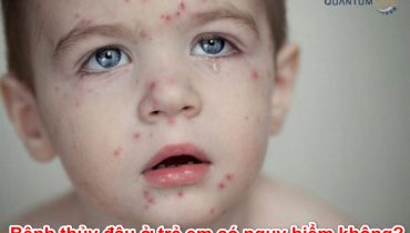 Bệnh thủy đậu ở trẻ em có nguy hiểm không, có gây vô sinh không