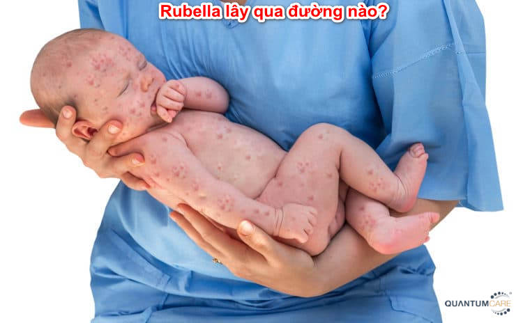 Bệnh rubella lây qua đường nào, làm thế nào phòng ngừa