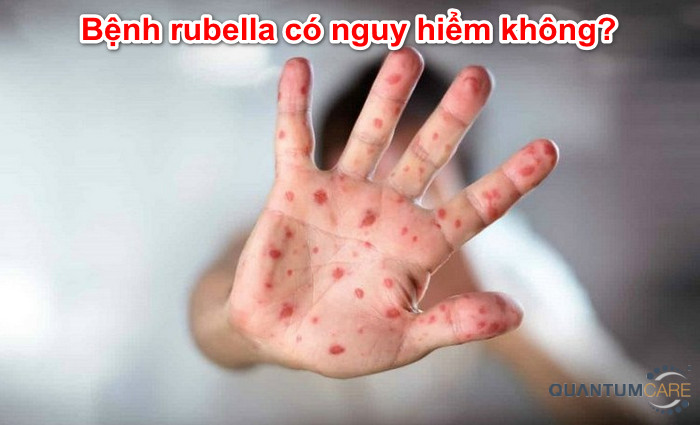 Bệnh rubella có nguy hiểm không, có tự khỏi không?