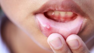 Nguyên nhân bị nhiệt miệng thường xuyên liên tục và cách chữa trị