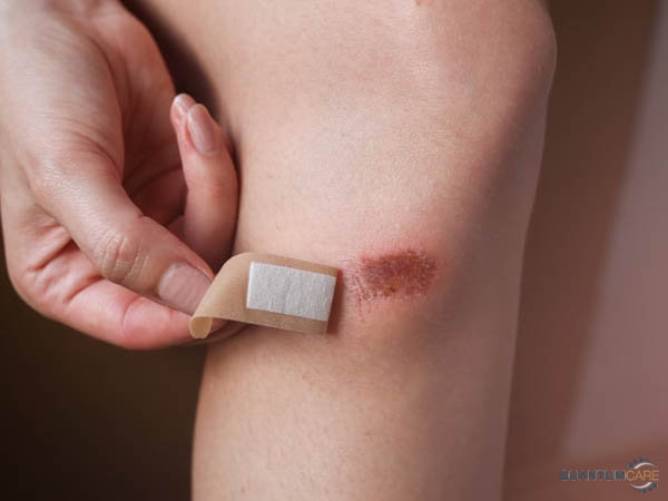 Cách sát trùng vết thương trầy xước té xe ở chân tay ngoài da