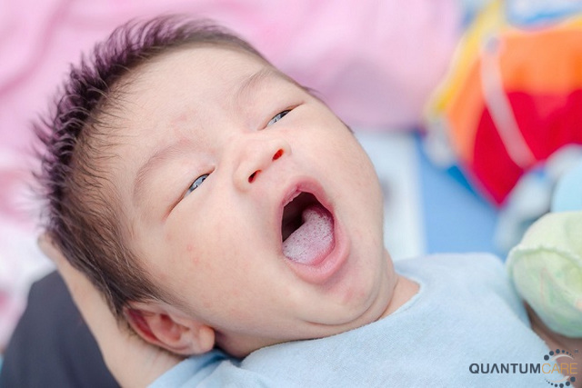 Cách chữa trị bệnh đẹn lưỡi ở trẻ sơ sinh tại nhà